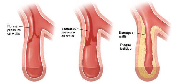 Com hipertensão, há uma violação da perviedade do canal vascular